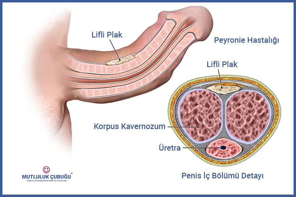 Peyronie hastalığı